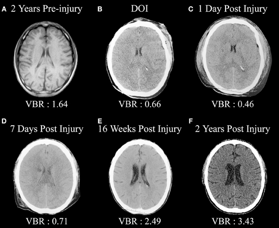 traumatic brain injury symptoms years later