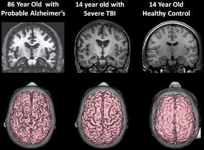 TBI Lawsuits Broward, Florida