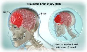 Traumatic Brain Injury Florida