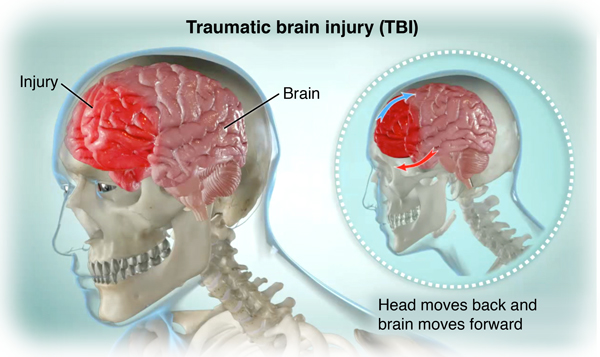 car accident image brain injury