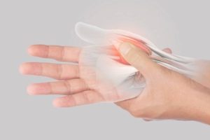 Carpal Tunnel Syndrome from A Car Accident
