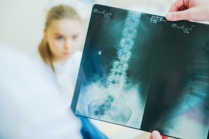can scoliosis be caused by a car accident